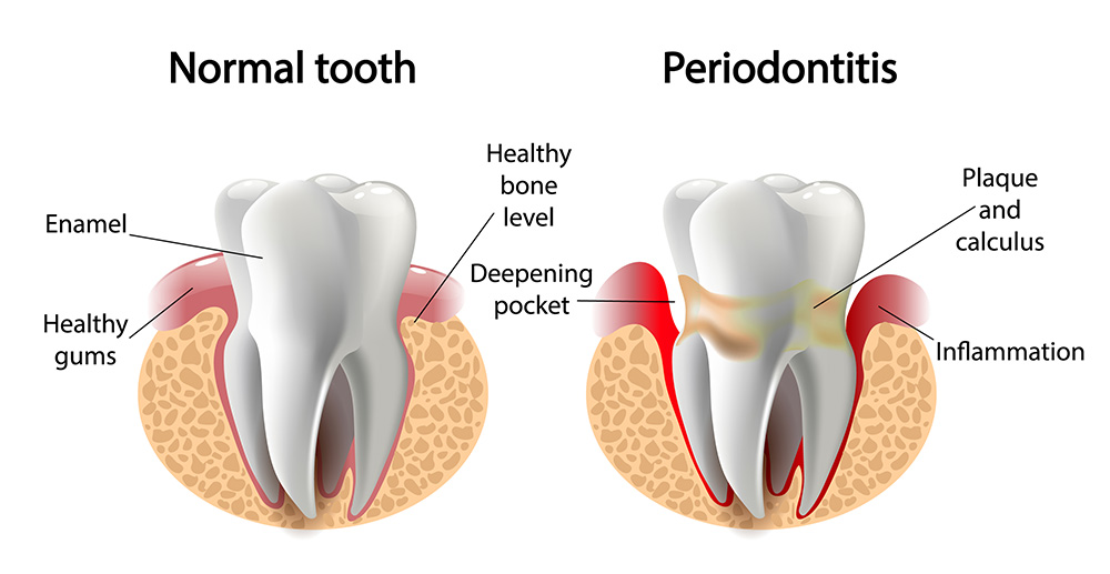 periodontal-diseases